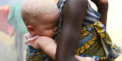African albino girl